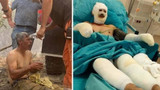 "Yanıyorum" diye feryat eden orman işçisinin tedavisi sürüyor