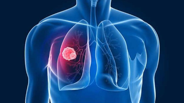 Kadınlarda akciğer kanseri oranı arttı!