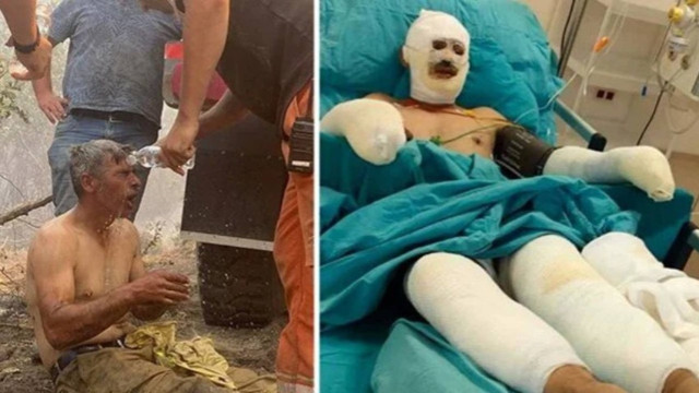 "Yanıyorum" diye feryat eden orman işçisinin tedavisi sürüyor