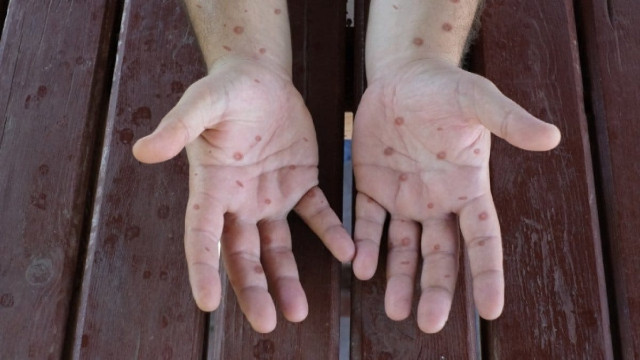 DSÖ'den maymun çiçeği alarmı: 'klad 1b' varyantı daha şiddetli ve ölümcül