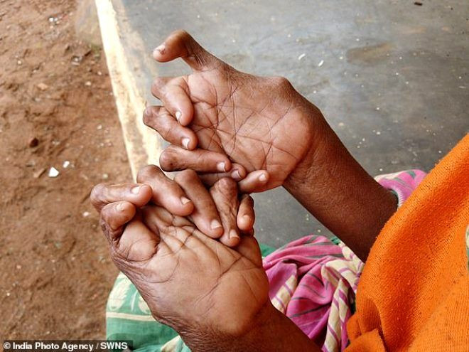 Doğuştan 31 parmaklı olan 63 yaşındaki kadın 'cadı' ilan edildi - Sayfa 1
