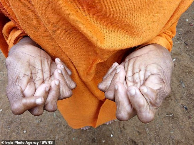 Doğuştan 31 parmaklı olan 63 yaşındaki kadın 'cadı' ilan edildi - Sayfa 4