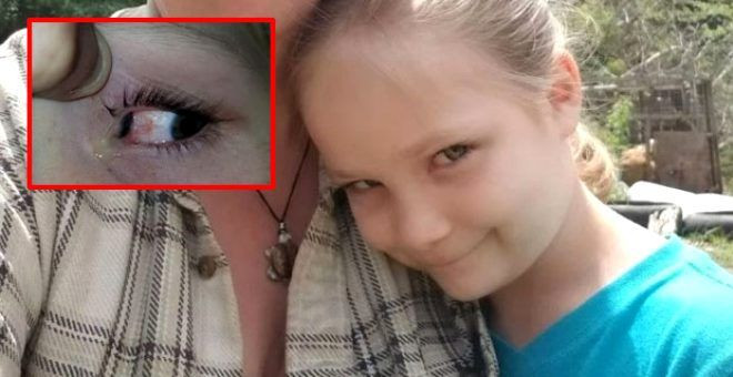 Acı içerisinde uyanan 6 yaşındaki kızın gözünden bezelye tanesi büyüklüğünde böcek çıktı - Sayfa 1
