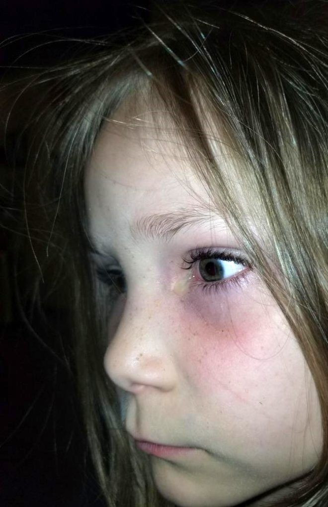 Acı içerisinde uyanan 6 yaşındaki kızın gözünden bezelye tanesi büyüklüğünde böcek çıktı - Sayfa 2