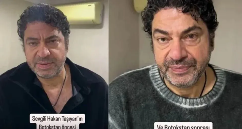 Hakan Taşıyan botoks yaptırdı! Sağlık sorunları vardı